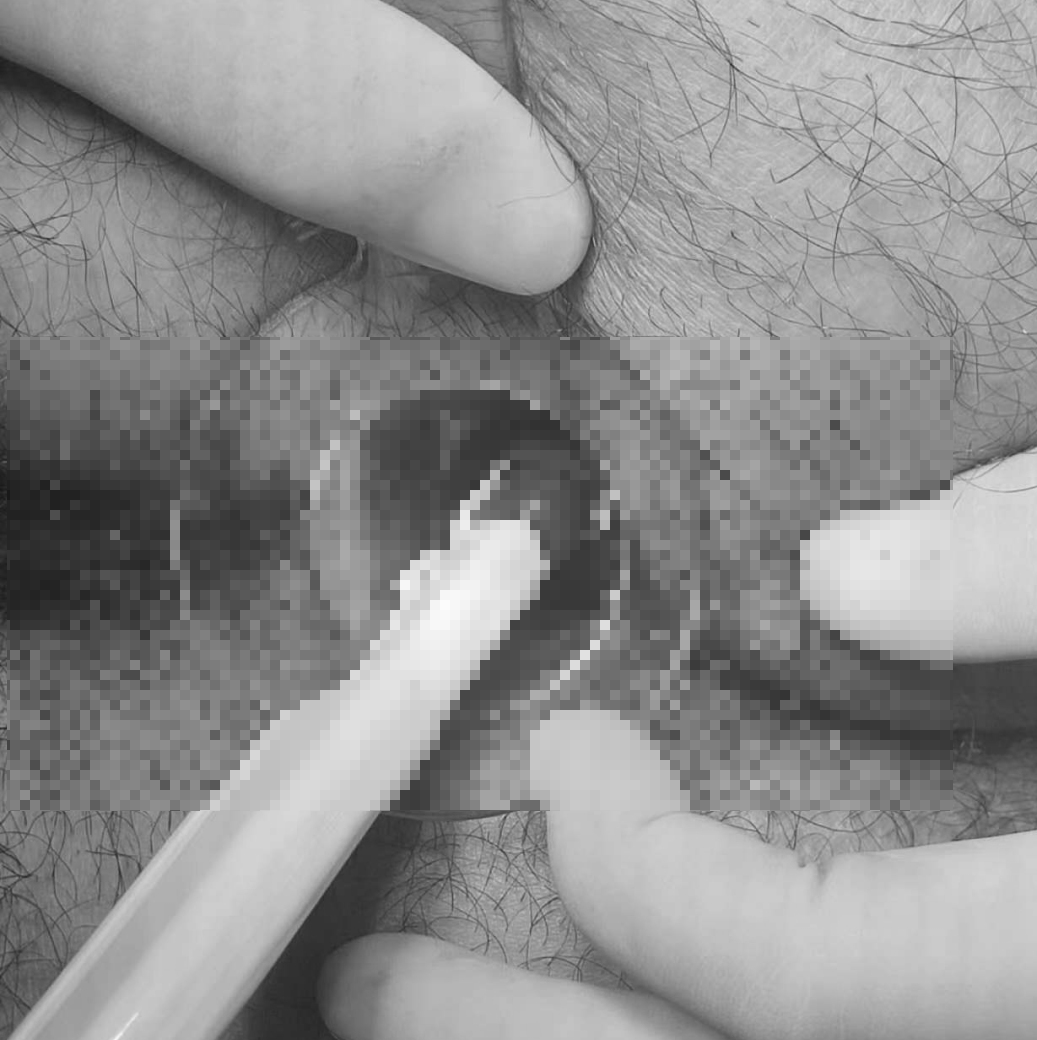 痔疮套扎吻合器怎么用“微创无痛”痔手术时代丨肛肠套扎吻合器首次在中医肛肠科痔手术中应用_https://www.jmylbn.com_新闻资讯_第7张