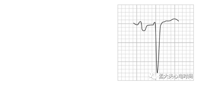p心电图功能怎么开通心电基础-P波_https://www.jmylbn.com_新闻资讯_第10张