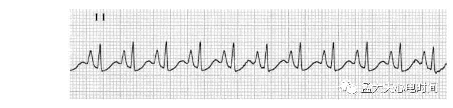 p心电图功能怎么开通心电基础-P波_https://www.jmylbn.com_新闻资讯_第5张