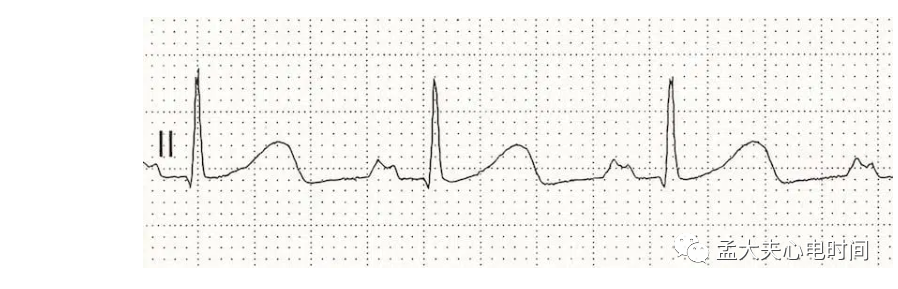 p心电图功能怎么开通心电基础-P波_https://www.jmylbn.com_新闻资讯_第7张