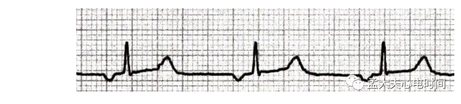 p心电图功能怎么开通心电基础-P波_https://www.jmylbn.com_新闻资讯_第13张