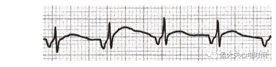 p心电图功能怎么开通心电基础-P波_https://www.jmylbn.com_新闻资讯_第12张