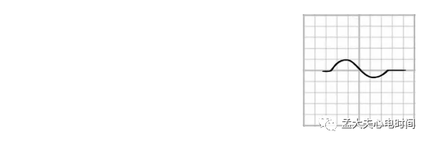 p心电图功能怎么开通心电基础-P波_https://www.jmylbn.com_新闻资讯_第8张
