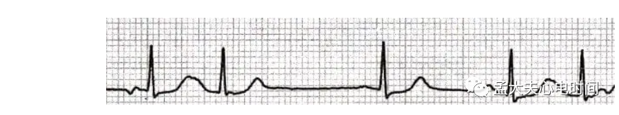 p心电图功能怎么开通心电基础-P波_https://www.jmylbn.com_新闻资讯_第14张