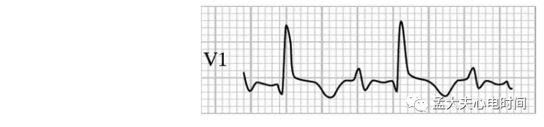 p心电图功能怎么开通心电基础-P波_https://www.jmylbn.com_新闻资讯_第9张