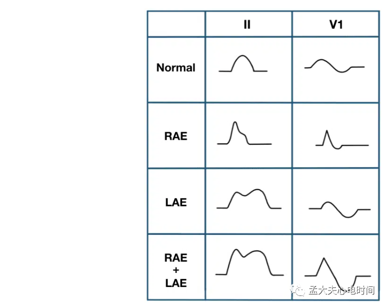 p心电图功能怎么开通心电基础-P波_https://www.jmylbn.com_新闻资讯_第11张
