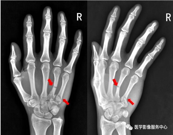 独立值班了这些骨折你都看出来了吗 附注解 医学影像服务中心 微信公众号文章阅读 Wemp