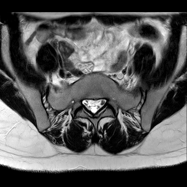 X线发现不了的骶骨骨折，要当心