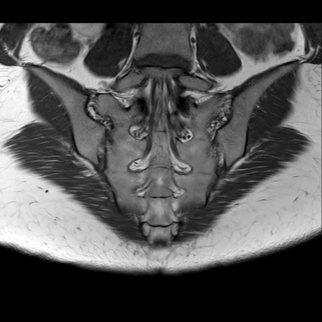 X线发现不了的骶骨骨折，要当心