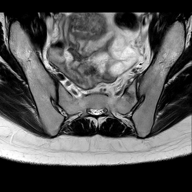 X线发现不了的骶骨骨折，要当心