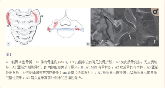 X线发现不了的骶骨骨折，要当心