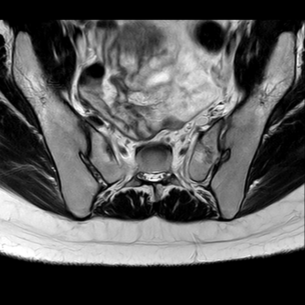 X线发现不了的骶骨骨折，要当心