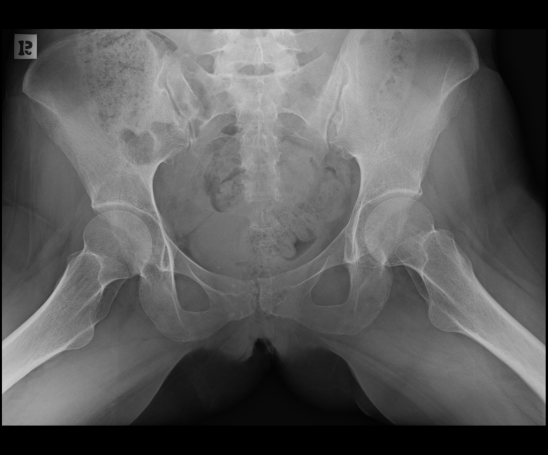 X线发现不了的骶骨骨折，要当心