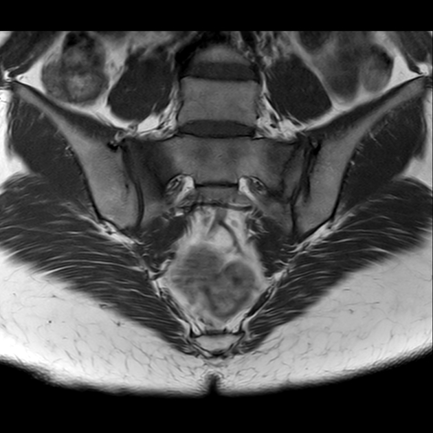 X线发现不了的骶骨骨折，要当心