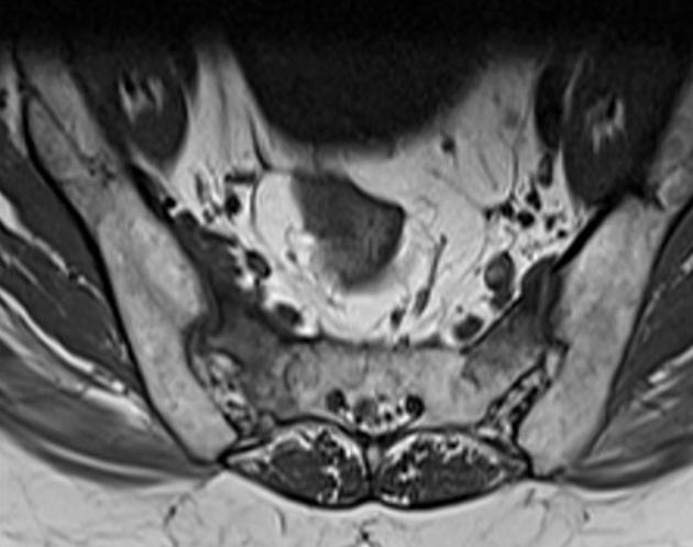 X线发现不了的骶骨骨折，要当心