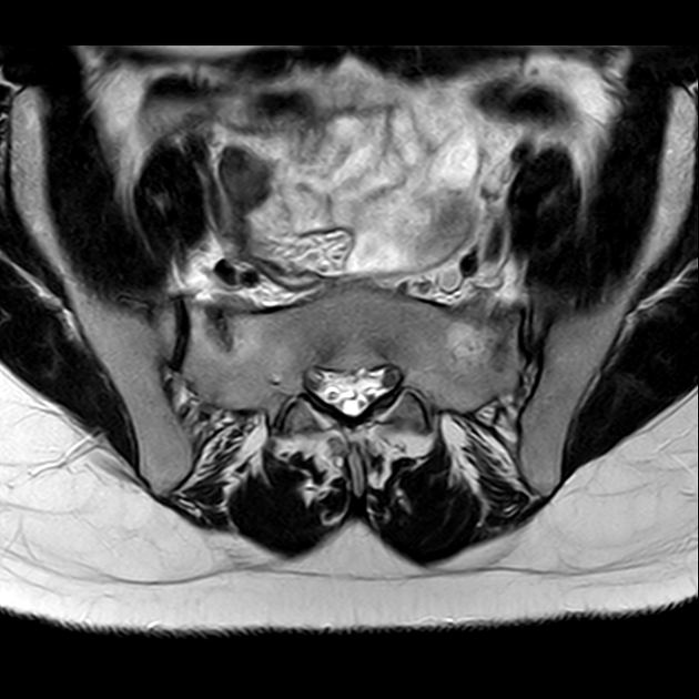 X线发现不了的骶骨骨折，要当心