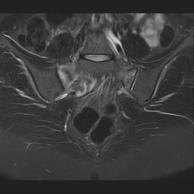 X线发现不了的骶骨骨折，要当心