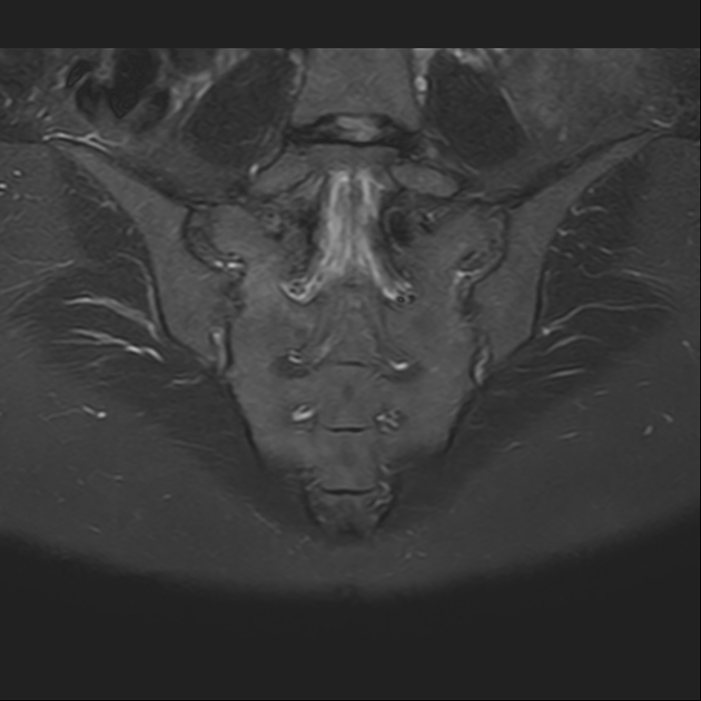 X线发现不了的骶骨骨折，要当心