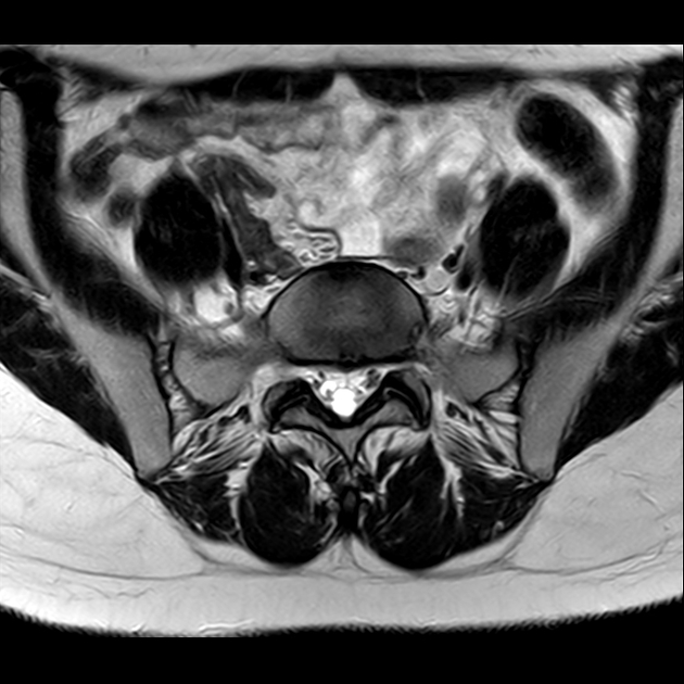 X线发现不了的骶骨骨折，要当心