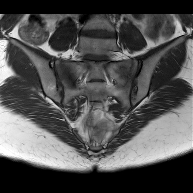 X线发现不了的骶骨骨折，要当心