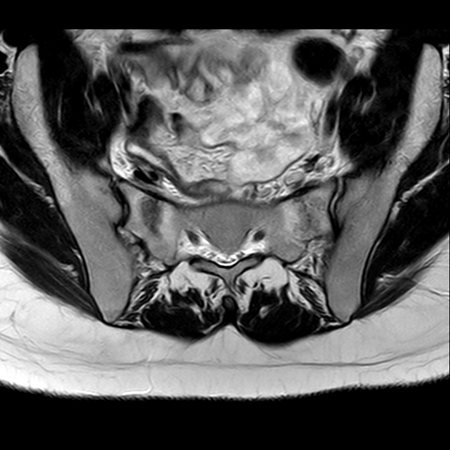 X线发现不了的骶骨骨折，要当心