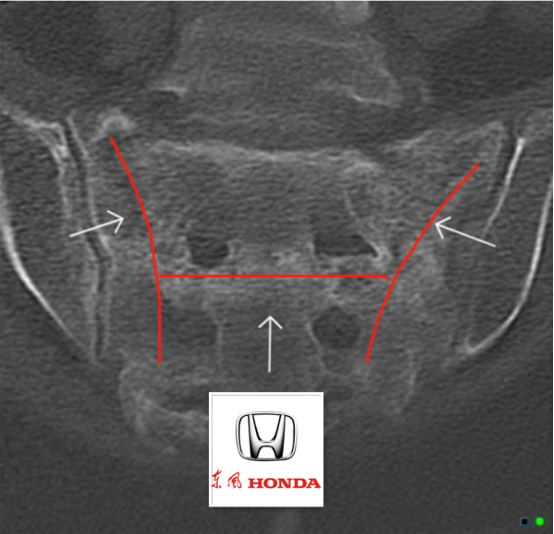 X线发现不了的骶骨骨折，要当心