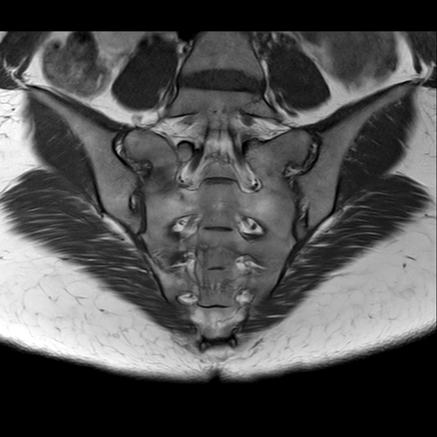 X线发现不了的骶骨骨折，要当心