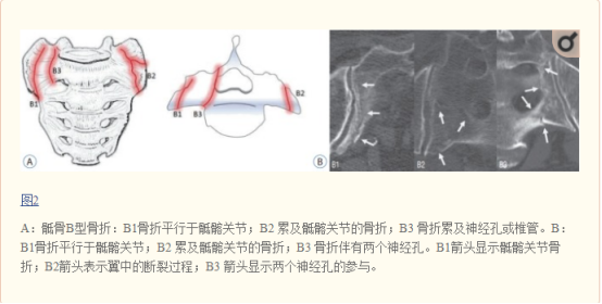X线发现不了的骶骨骨折，要当心