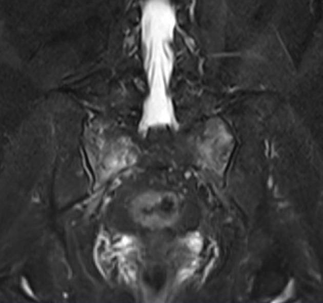 X线发现不了的骶骨骨折，要当心