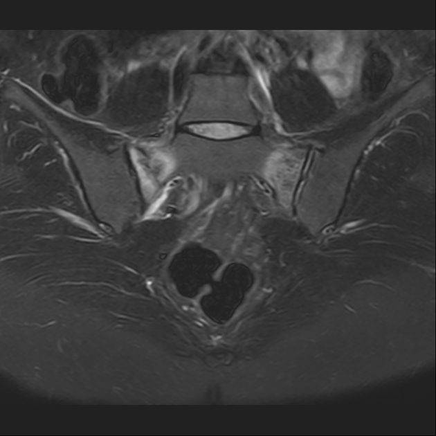X线发现不了的骶骨骨折，要当心
