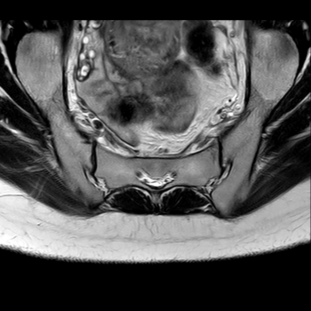 X线发现不了的骶骨骨折，要当心