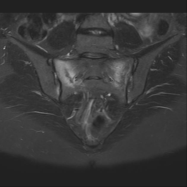 X线发现不了的骶骨骨折，要当心