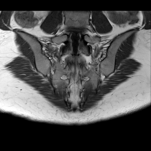 X线发现不了的骶骨骨折，要当心