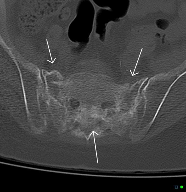 X线发现不了的骶骨骨折，要当心