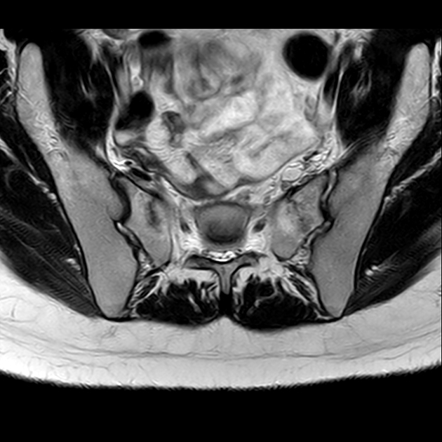 X线发现不了的骶骨骨折，要当心