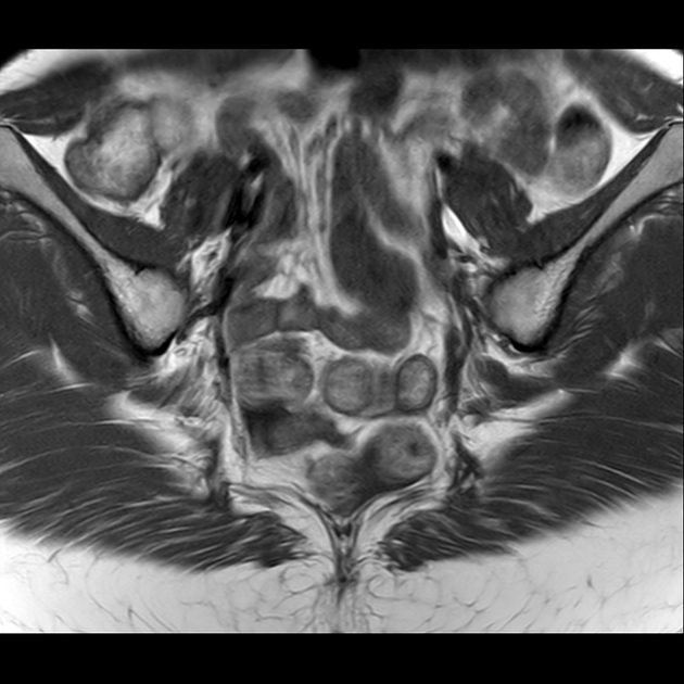 X线发现不了的骶骨骨折，要当心