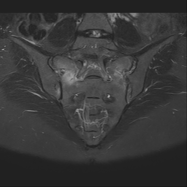 X线发现不了的骶骨骨折，要当心