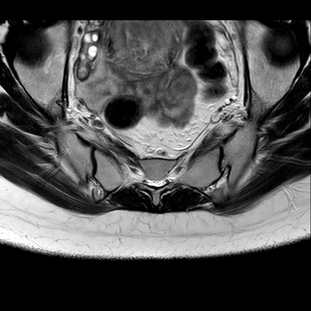 X线发现不了的骶骨骨折，要当心