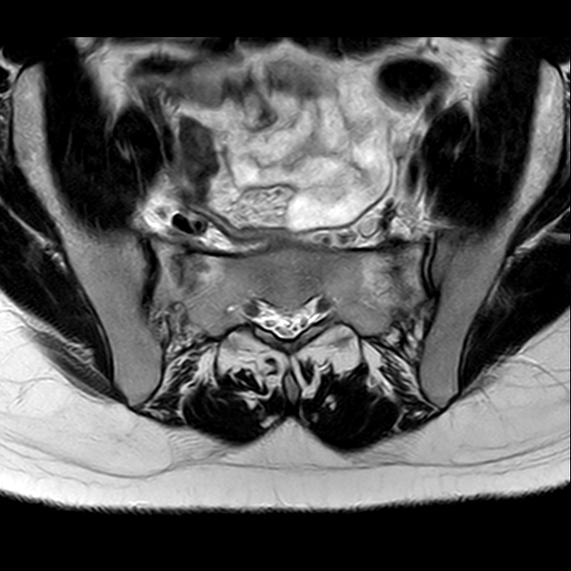 X线发现不了的骶骨骨折，要当心