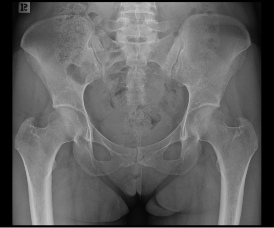 X线发现不了的骶骨骨折，要当心