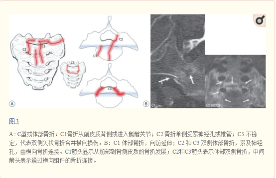 X线发现不了的骶骨骨折，要当心