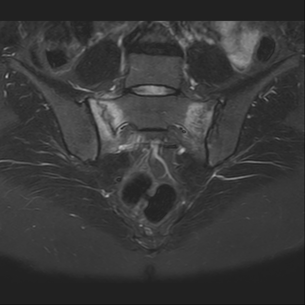 X线发现不了的骶骨骨折，要当心
