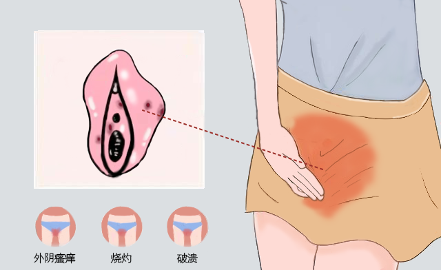 4006B光疗怎么用光疗仪器治疗外阴白斑有用吗？_https://www.jmylbn.com_新闻资讯_第4张