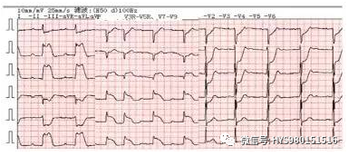心电监护怎么看图【PLUS版】心电图危急值识别及紧急处理，值得每个医生收藏！！！_https://www.jmylbn.com_新闻资讯_第7张