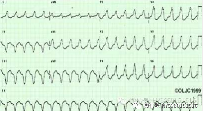 心电监护怎么看图【PLUS版】心电图危急值识别及紧急处理，值得每个医生收藏！！！_https://www.jmylbn.com_新闻资讯_第12张