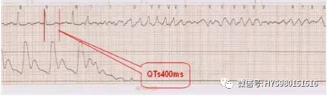 心电监护怎么看图【PLUS版】心电图危急值识别及紧急处理，值得每个医生收藏！！！_https://www.jmylbn.com_新闻资讯_第13张