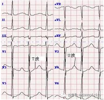 心电监护怎么看图【PLUS版】心电图危急值识别及紧急处理，值得每个医生收藏！！！_https://www.jmylbn.com_新闻资讯_第23张