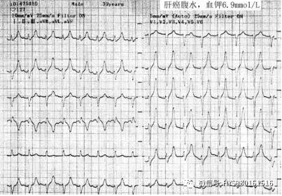 心电监护怎么看图【PLUS版】心电图危急值识别及紧急处理，值得每个医生收藏！！！_https://www.jmylbn.com_新闻资讯_第22张