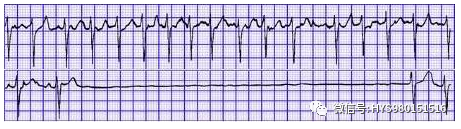 心电监护怎么看图【PLUS版】心电图危急值识别及紧急处理，值得每个医生收藏！！！_https://www.jmylbn.com_新闻资讯_第20张