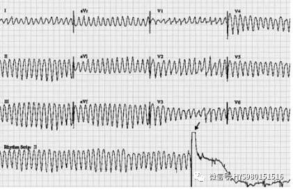 心电监护怎么看图【PLUS版】心电图危急值识别及紧急处理，值得每个医生收藏！！！_https://www.jmylbn.com_新闻资讯_第16张